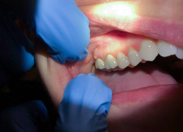 Best Emergency Dentist for Lost Fillings or Crowns in Redland, AL