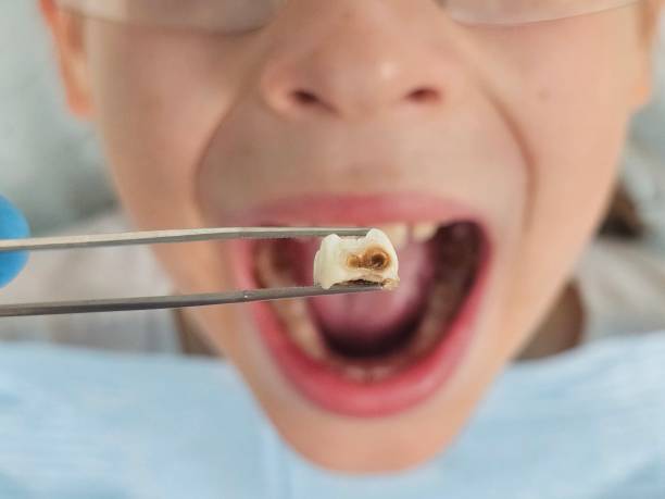 Best Broken or Cracked Tooth Emergency Dentist in Redland, AL